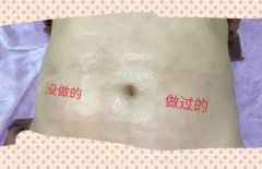 去妊娠紋機器多少錢一臺？美容院去除妊娠紋機器設備價格