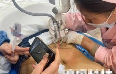 妊娠紋用什么儀器能去除？妊娠紋修復(fù)儀器廠家_最新祛妊娠紋的儀器